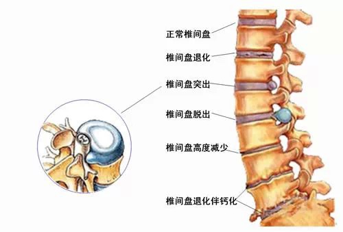 针刀治疗腰椎间盘突出症