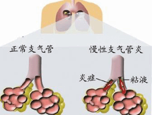针刀治疗慢性支气管炎