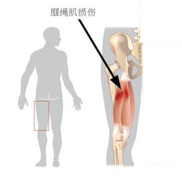 每日一“击”之半腱肌、半膜肌
