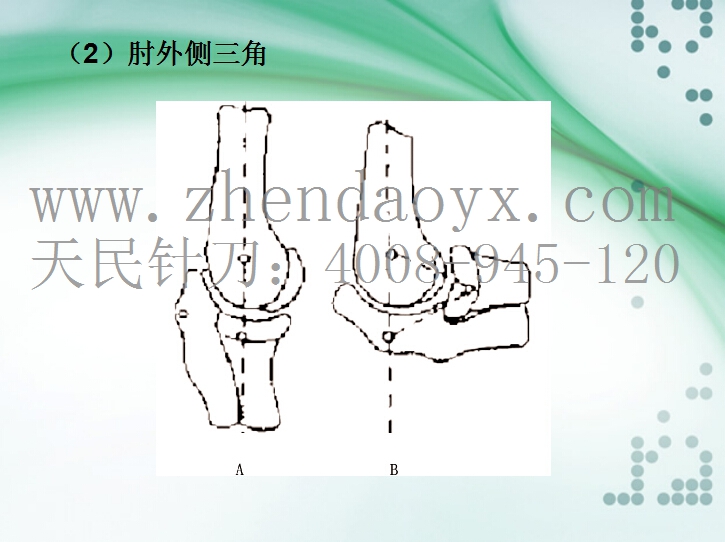 针刀治疗肘关节强直