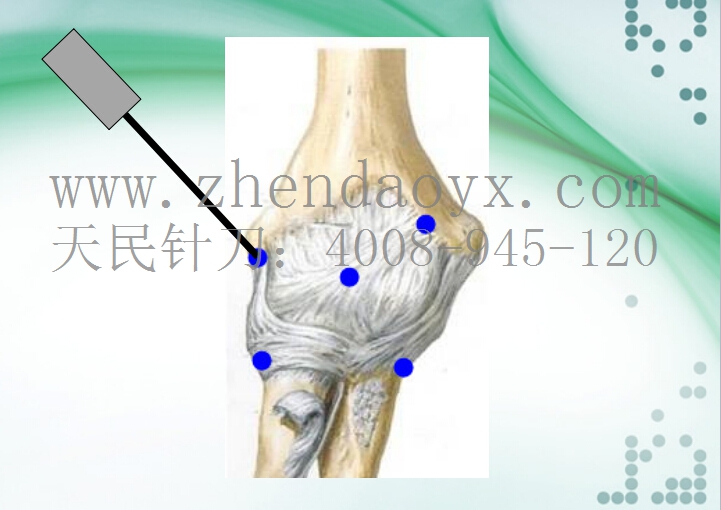 针刀治疗肘关节强直