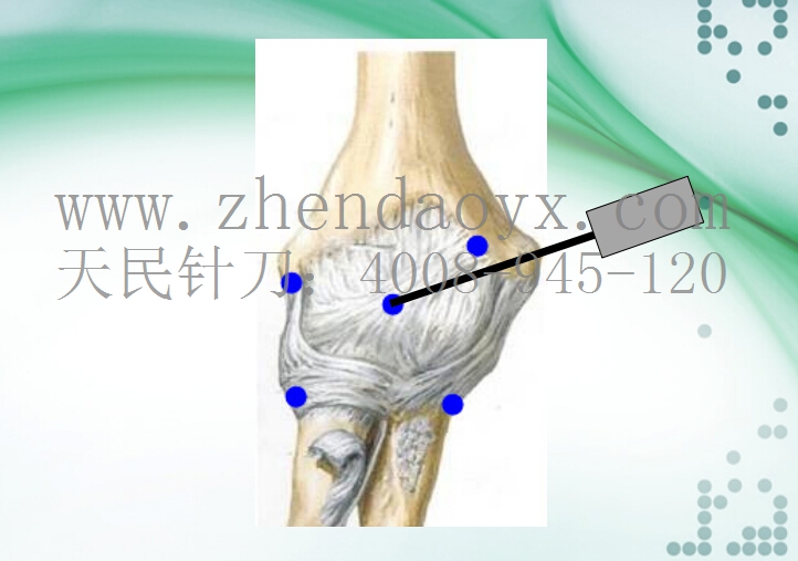 针刀治疗肘关节强直