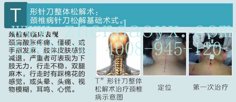 张天民针刀整体松解术