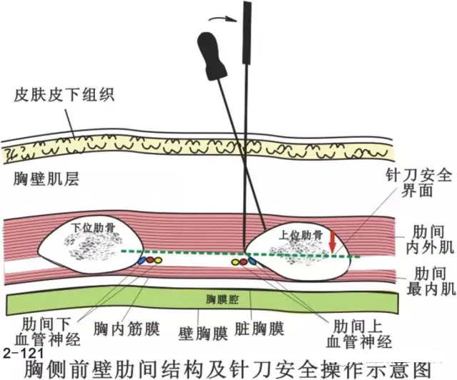 腹外斜肌损伤的针刀治疗