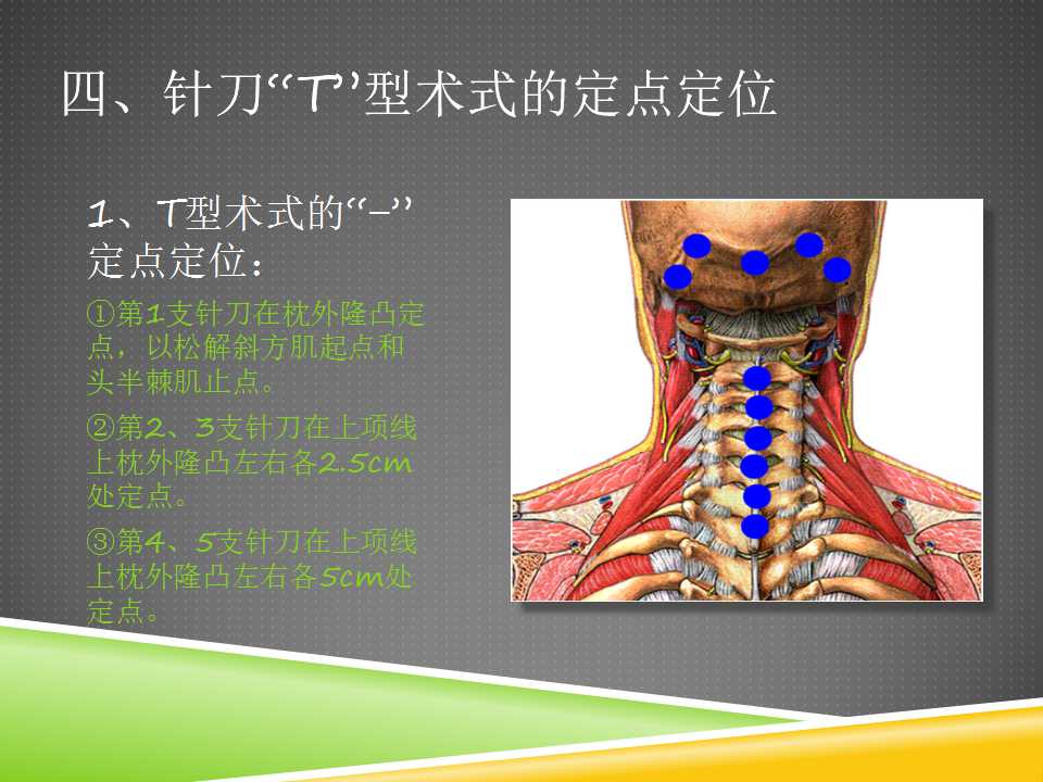 t型针刀整体松解术治疗颈性眩晕上