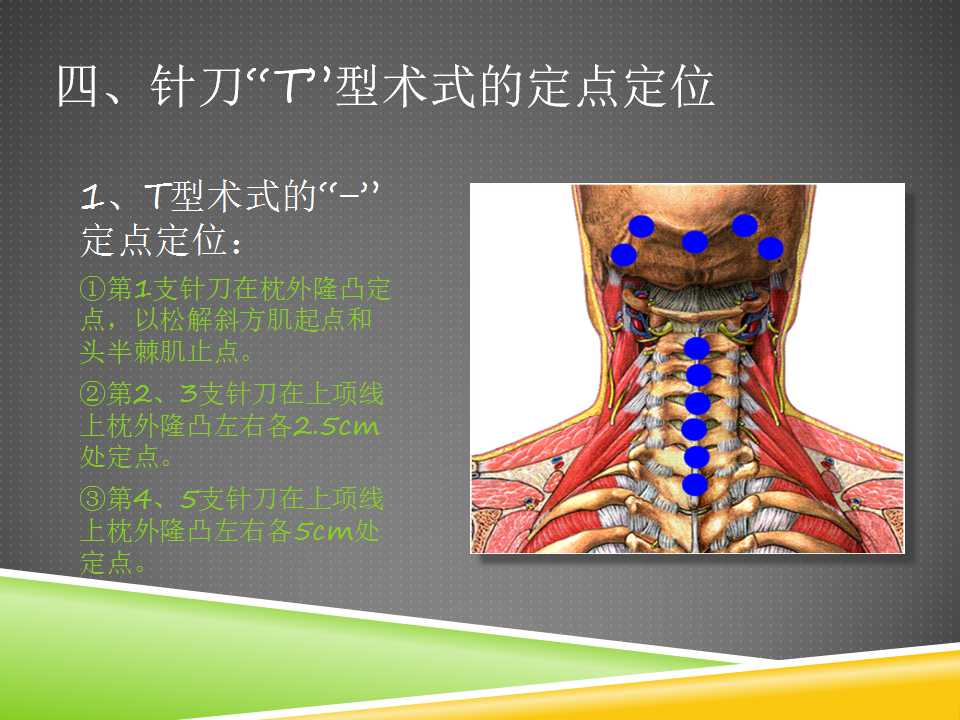 秦保和T型针刀整体松解术治疗颈性眩晕