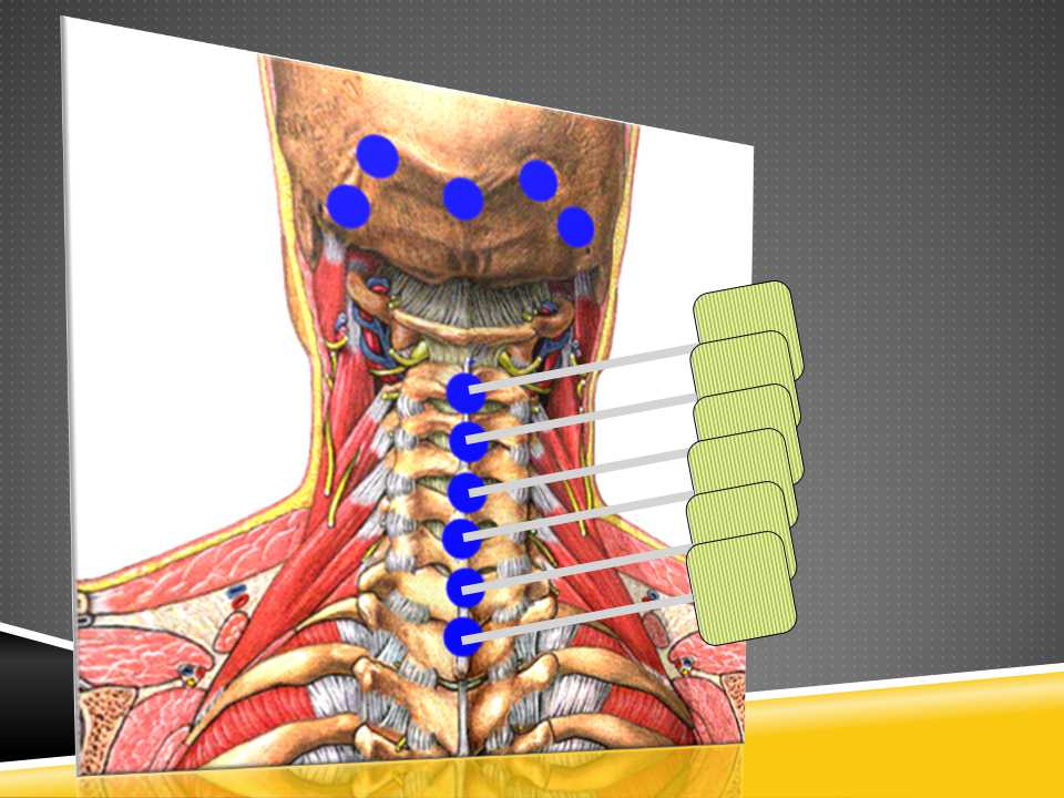 秦保和T型针刀整体松解术治疗颈性眩晕