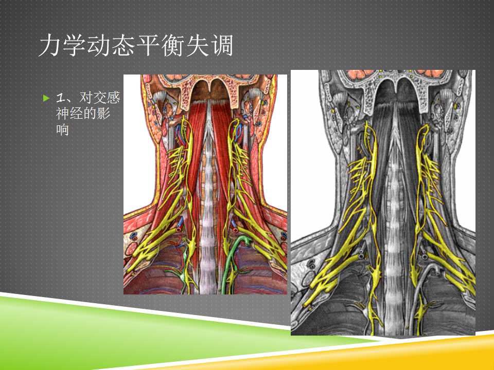 秦保和T型针刀整体松解术治疗颈性眩晕