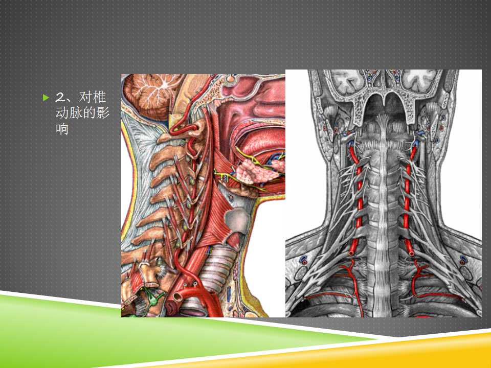 秦保和T型针刀整体松解术治疗颈性眩晕