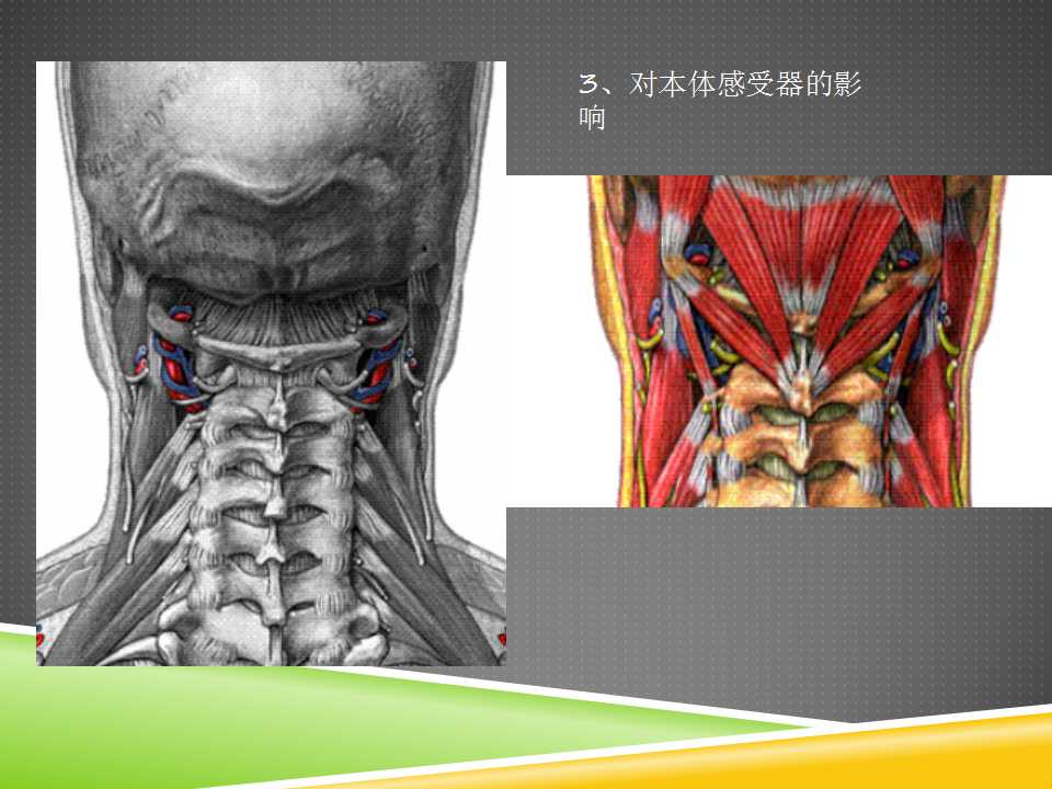 秦保和T型针刀整体松解术治疗颈性眩晕