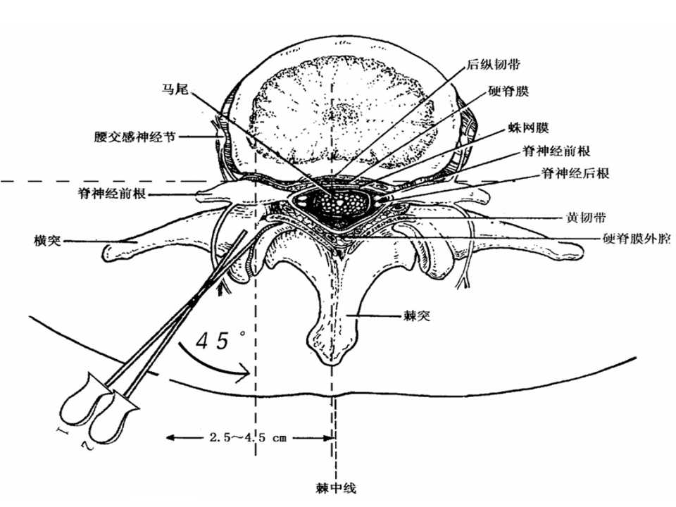小针刀培训之腰椎横突的体表定位