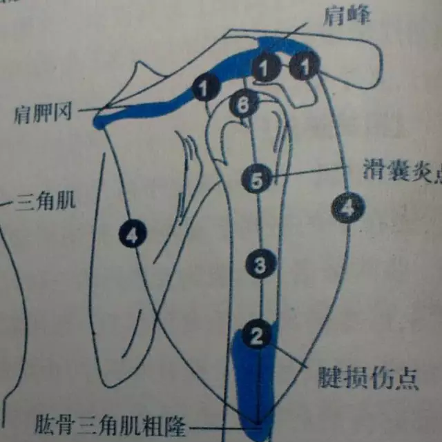 针刀解剖三角肌