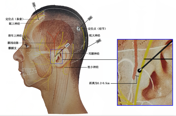 针刀治疗偏头痛的方法