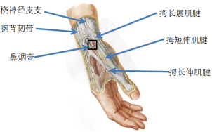 桡骨茎突狭窄性腱鞘炎解剖示意图