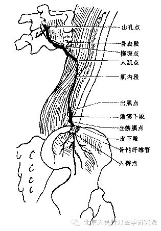 针刀治疗臀上皮神经卡压综合征