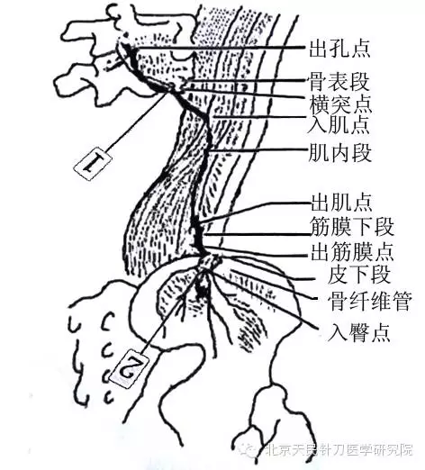 针刀治疗臀上皮神经卡压综合征