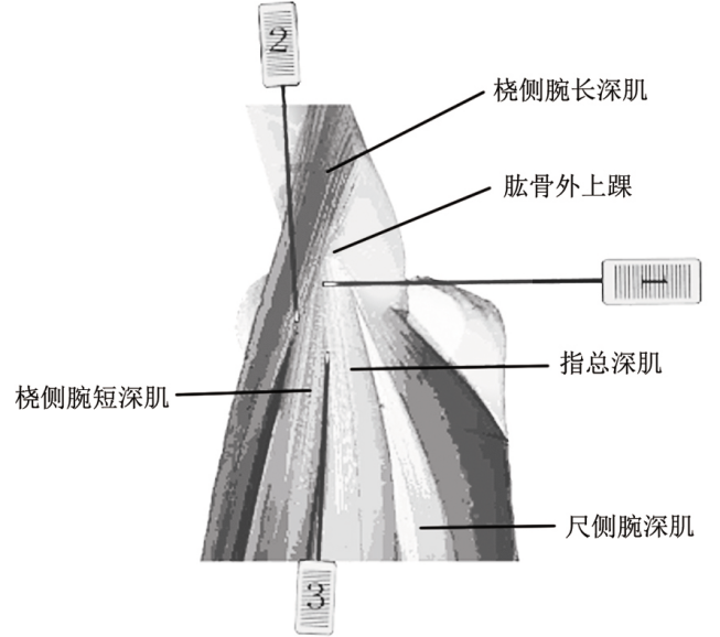 张天民教授针刀治疗肱骨外上髁炎案例分享