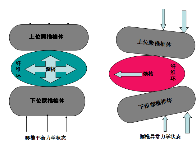天民针刀治疗腰椎间盘突出症