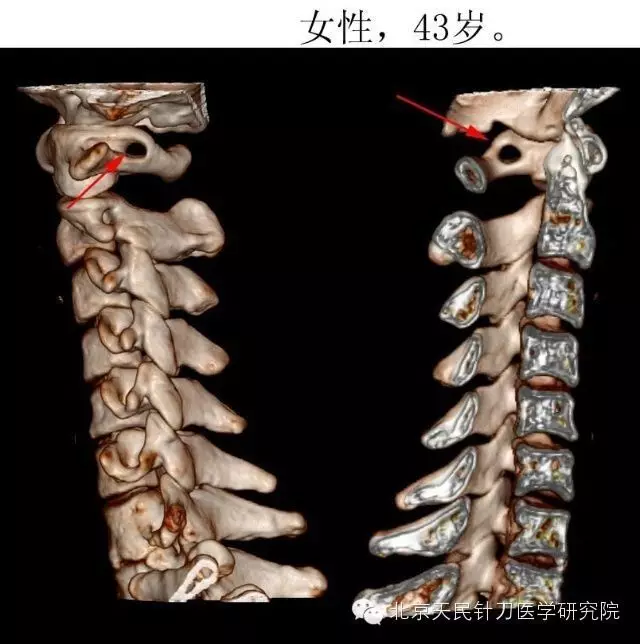 被很多人"视而不见"的环椎后桥