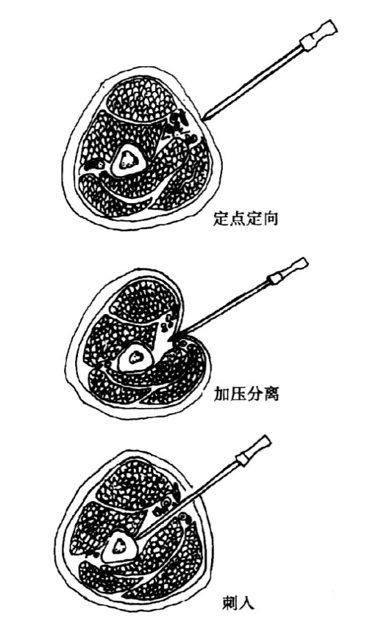 张天民四步进针规程
