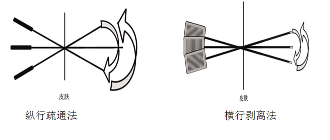 张天民四步进针规程
