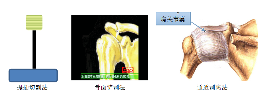 张天民四步进针规程