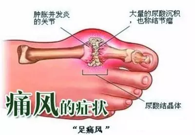 针刀治疗痛风