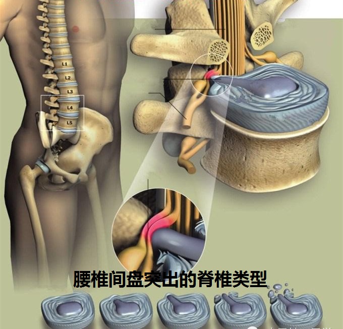 天民针刀培训-腰间盘突出