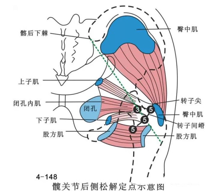 股骨头坏死针刀治疗精要