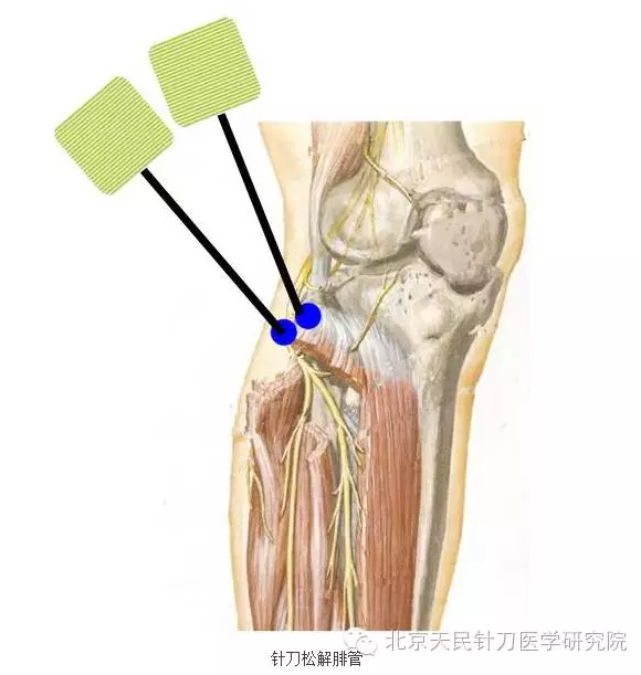 针刀治疗腓总神经卡压综合征