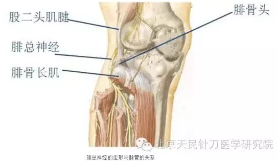 针刀治疗腓总神经卡压综合征