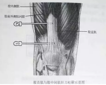 针刀治疗风湿性关节病