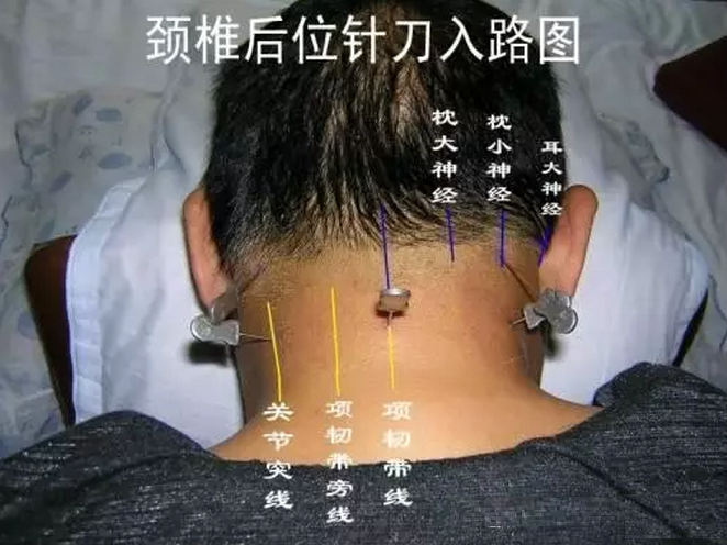 针刀治疗颈椎病