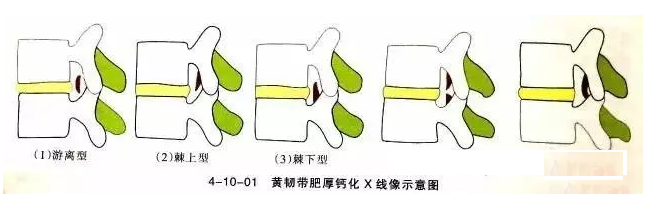 针刀治疗黄韧带肥厚骨化症