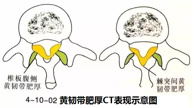 针刀治疗黄韧带肥厚骨化症图解