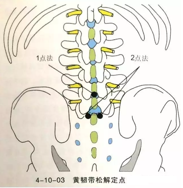 针刀治疗黄韧带肥厚骨化症