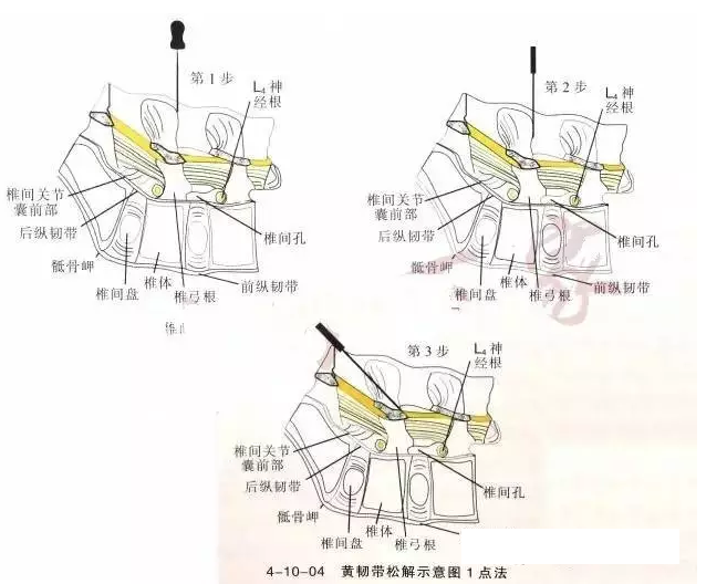 针刀治疗黄韧带肥厚骨化症