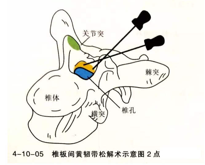 针刀治疗黄韧带肥厚骨化症