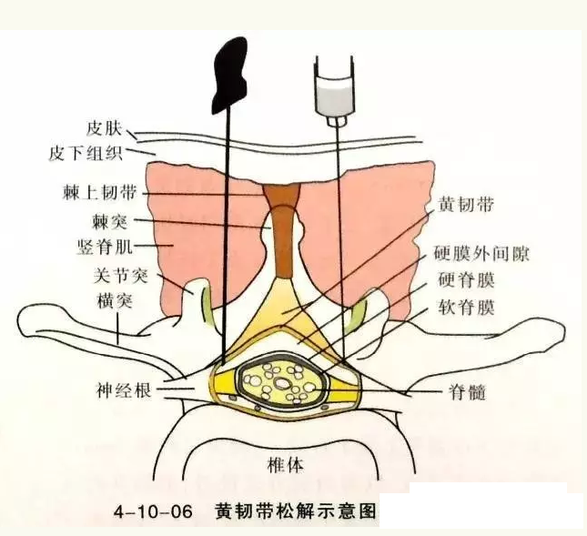 针刀治疗黄韧带肥厚骨化症