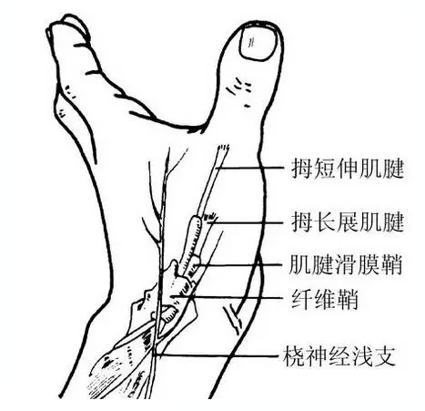 针刀松解屈指肌腱狭窄性腱鞘炎