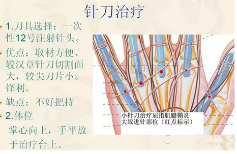 针刀松解屈指肌腱狭窄性腱鞘炎