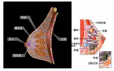 针刀治疗乳腺增生临床经验