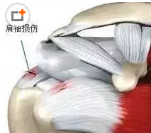 针刀治疗肩周炎