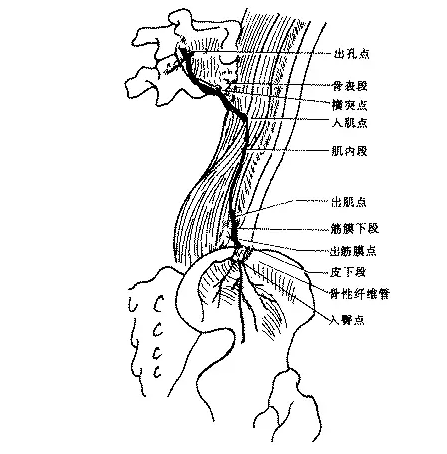 针刀臀部