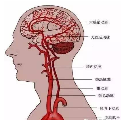 针刀治疗脑血管病后遗症