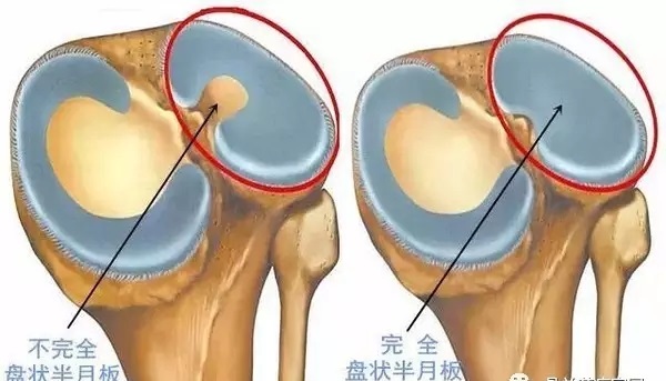 不可忽视的盘状半月板