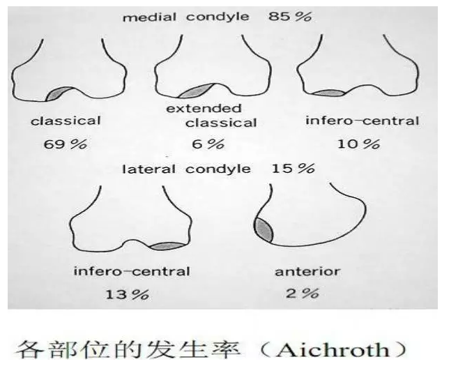 22种引起膝关节疼痛的常见疾病