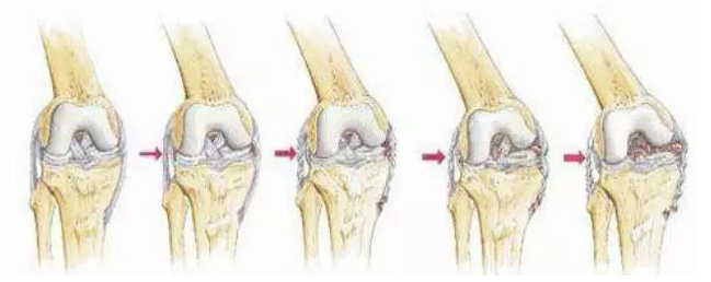 22种引起膝关节疼痛的常见疾病