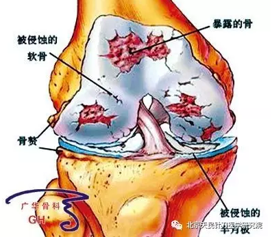 针刀松解髌下脂肪垫